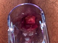 Intense Anal Speculum Gaping On Big Ass Slut With Hairy Pussy