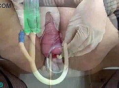 extreme cervix prolapse with bottles hanging of the uterus
